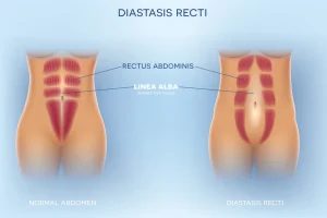 How To Fix Diastasis Recti Years Later A Comprehensive Guide For Long