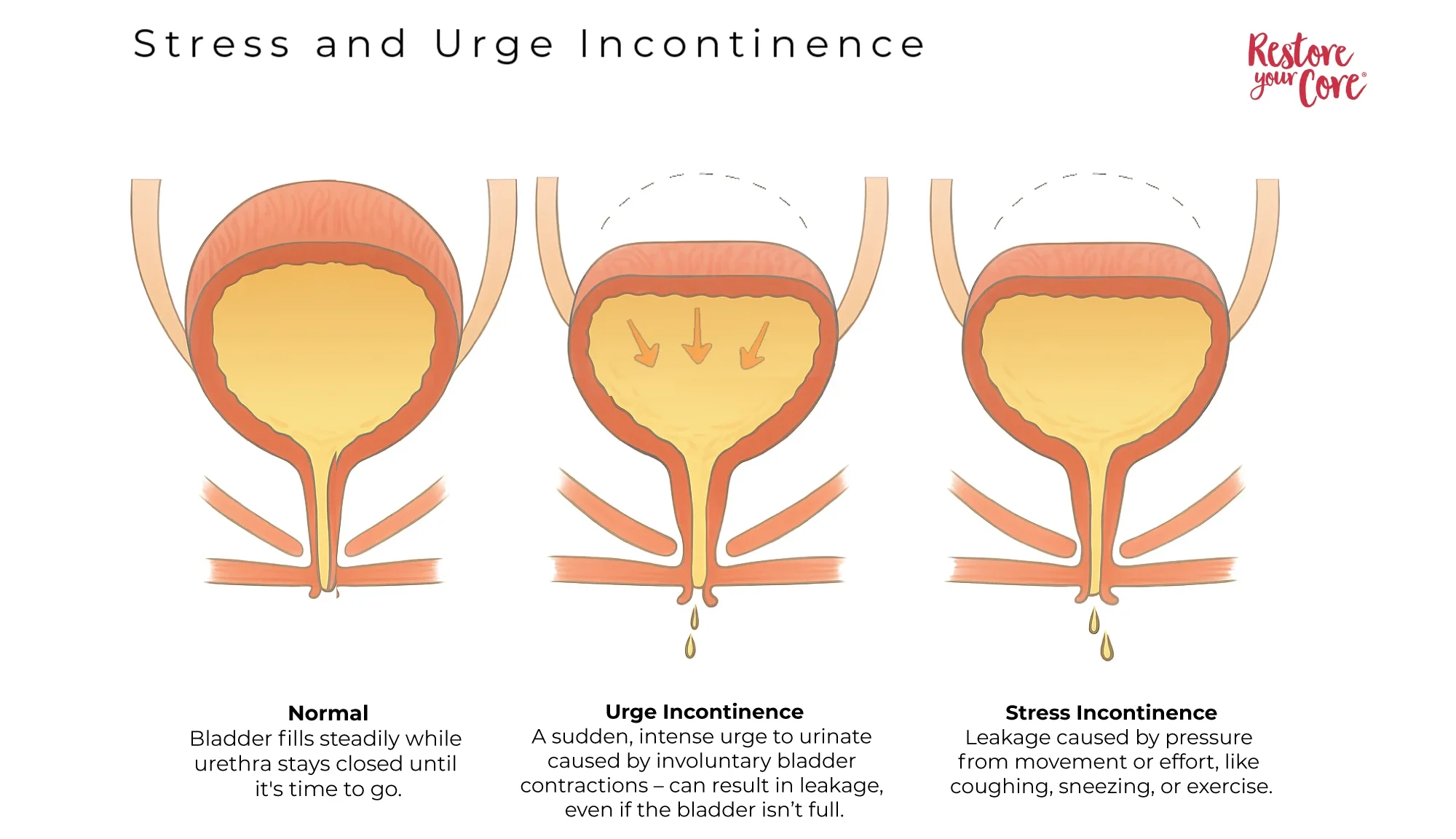 Stress and Urgency Incontinence – RYC®