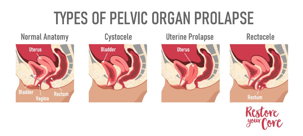 What is Pelvic Organ Prolapse?  Types of Prolapse, Diagnosis, Treatment