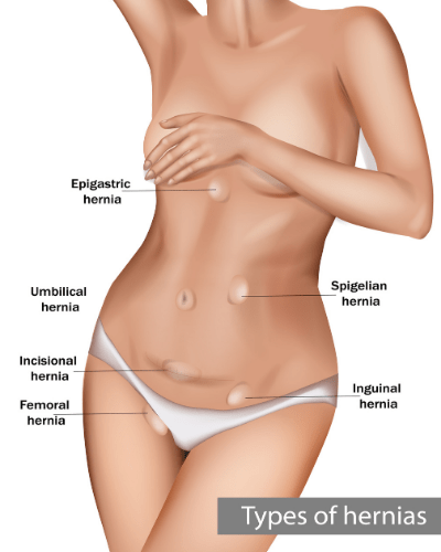 woman hernia