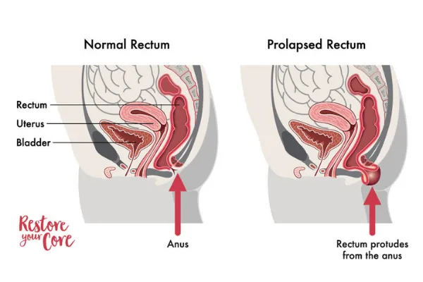 Locations of the rectum in the pelvic cavity and of the normal