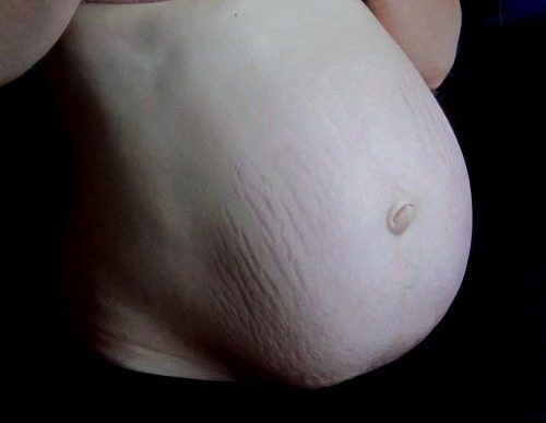 This is what stretch marks look like on a pregnant woman