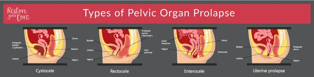 [get 22 ] Uterine Prolapse Surgery Recovery Time