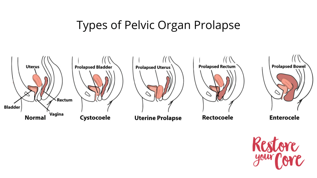 types of pelvic organ prolapse