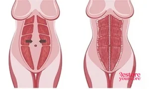 What the body looks like after diastasis recti surgery