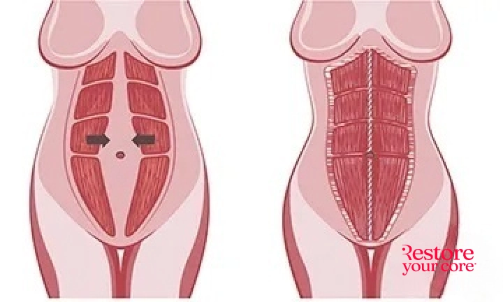 What the body looks like after diastasis recti surgery