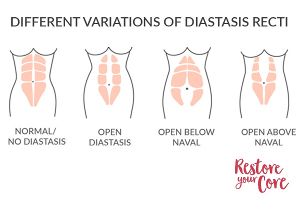 a and b) Clinical presentation of diastasis recti W3 b a