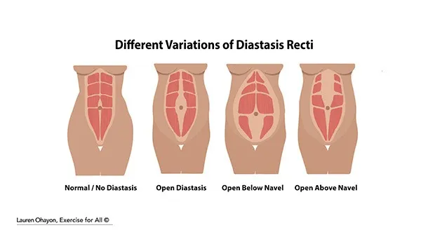 What Does Diastasis Recti Look Like Ryc