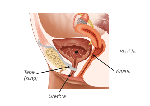 Bladder sling insert