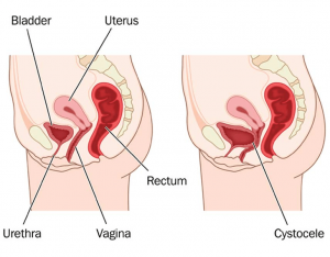 What cystocele looks like