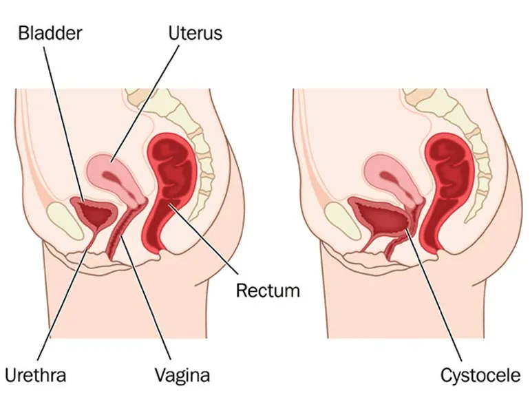 What is Cystocele? - RYC®