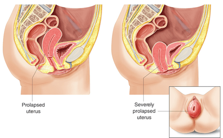 How to Stop a Prolapse from Getting Worse - RYC®