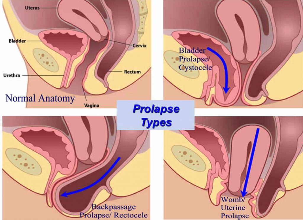 prolapsed bladder repair