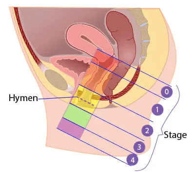 cystocele grading