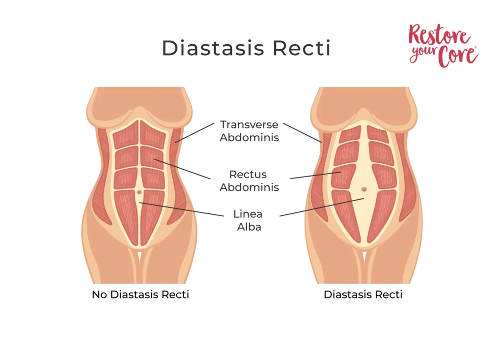 Diastasis Recti – RYC®