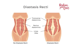 Diastasis Recti – RYC®