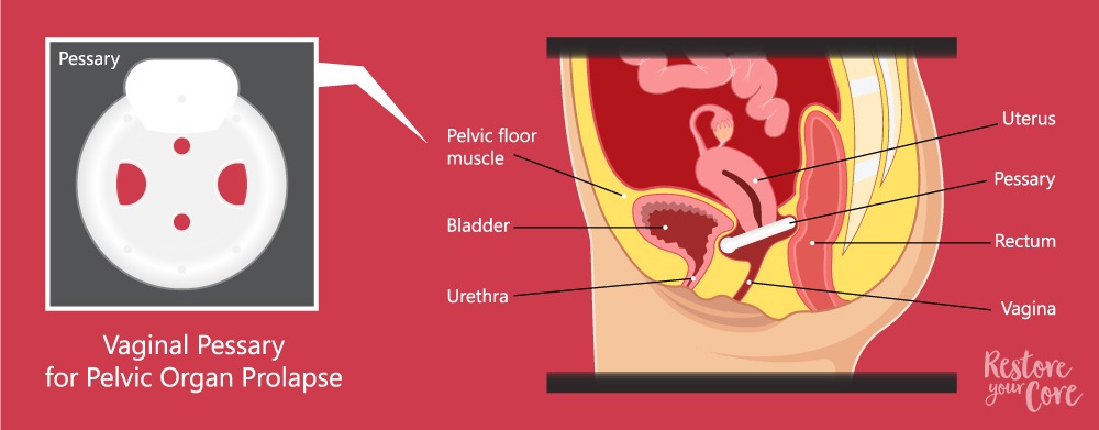 Older Surgical Procedure for Pelvic Prolapse Repair Prevails in