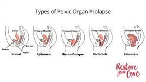 Types of pelvic organ prolapse (left to right): Normal, cystocoele, uterine prolapse, rectocoele, enterocele