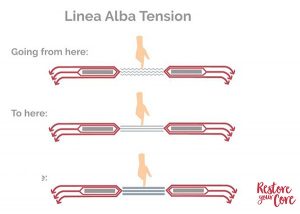 Before & After Diastasis Recti – Real Healing Results