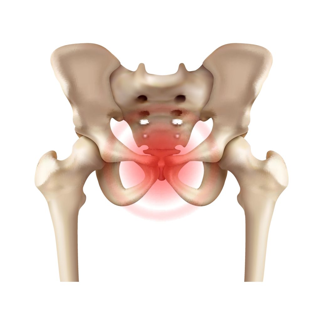 Symphysis Pubis Dysfunction, SPD.