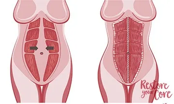 What diastasis recti looks like after surgery