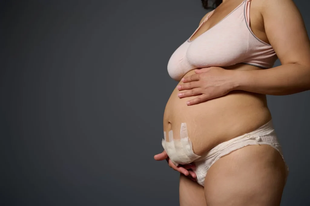 woman after C-section