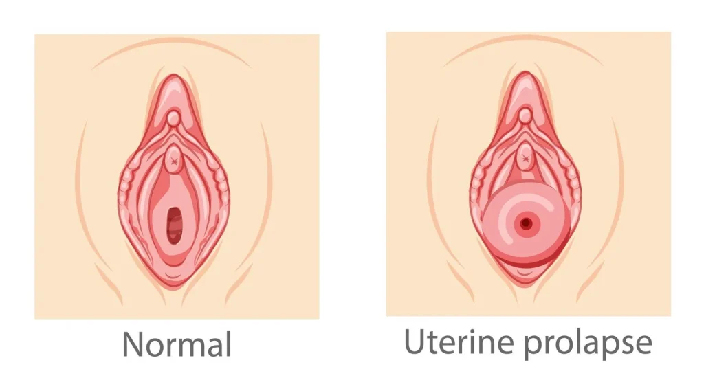 Set Of Uterine Prolapse Female Reproductive System Women Perineum Uterus Normal And With Disease Pain