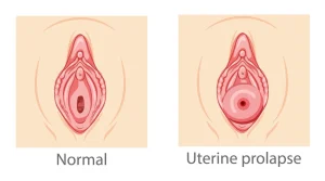 Set Of Uterine Prolapse Female Reproductive System Women Perineum Uterus Normal And With Disease Pain