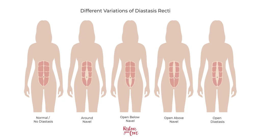 Different Variations of DR – RYC®
