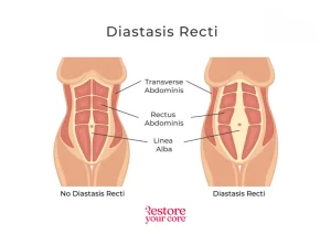 RYC-Diastasis-Recti – RYC®
