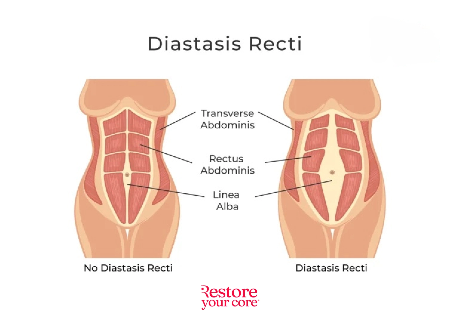 RYC-Diastasis-Recti – RYC®