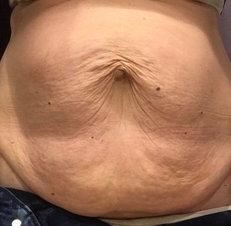 Stretched-Skin-resized.jpg