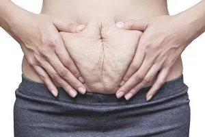 diastasis recti – RYC®