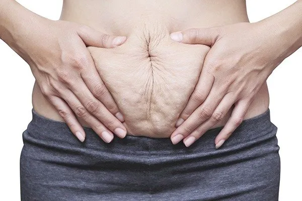 diastasis recti