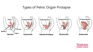 Types of pelvic organ prolapse (left to right): Normal, cystocoele, uterine prolapse, rectocoele, enterocele