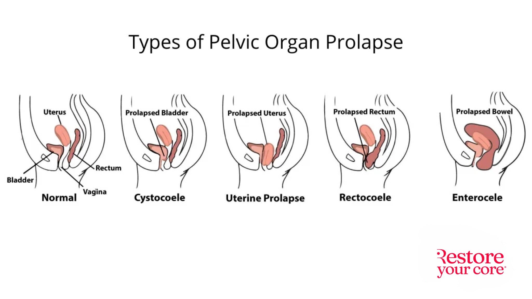 Types of pelvic organ prolapse (left to right): Normal, cystocoele, uterine prolapse, rectocoele, enterocele