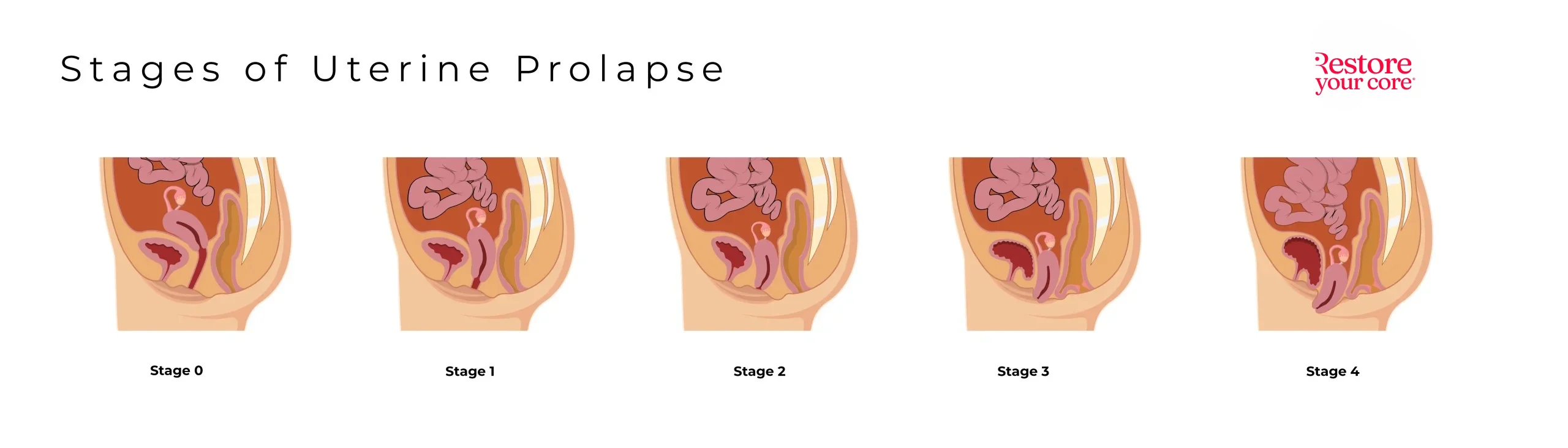 Uterine Prolapse Stages