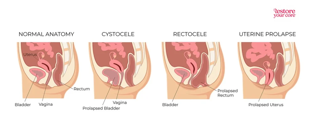 Types of pelvic organ prolapse (left to right): Normal, cystocoele, uterine prolapse, rectocoele, enterocele