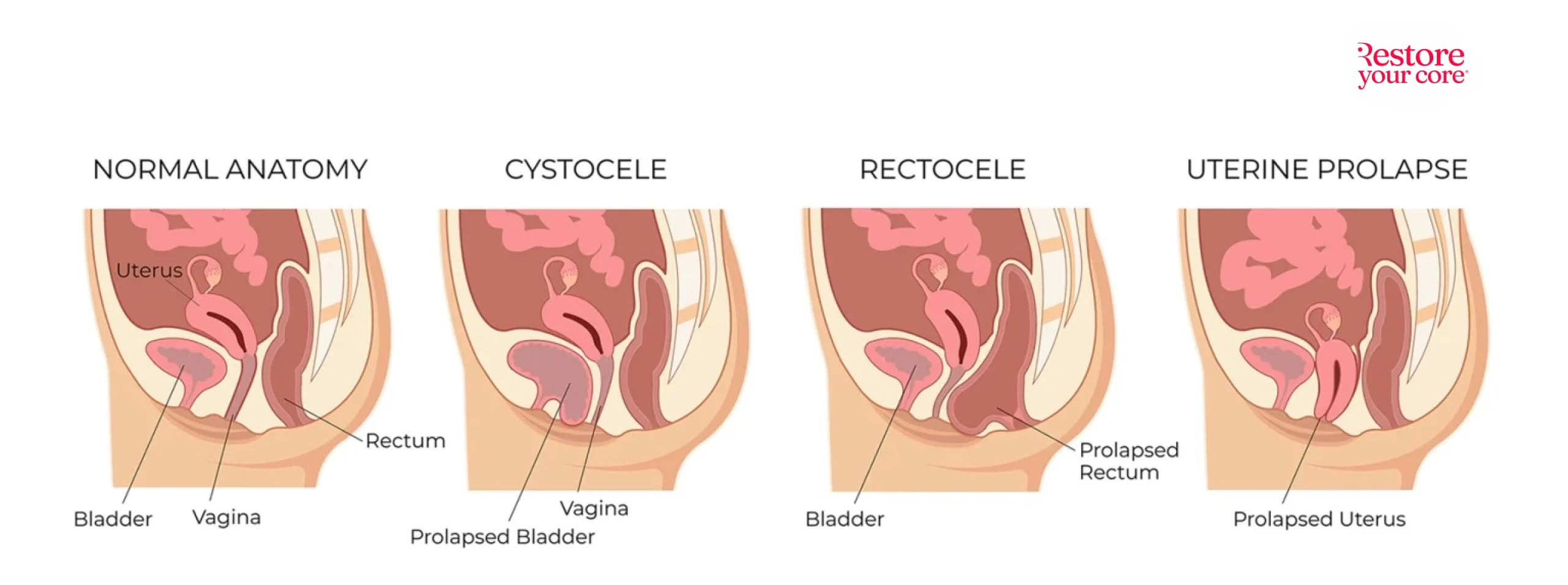 Types of pelvic organ prolapse (left to right): Normal, cystocoele, uterine prolapse, rectocoele, enterocele