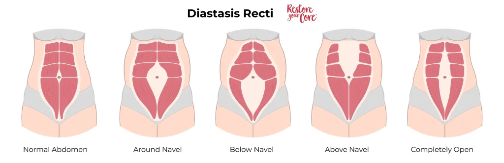 Heal Diastasis Recti with RYC®
