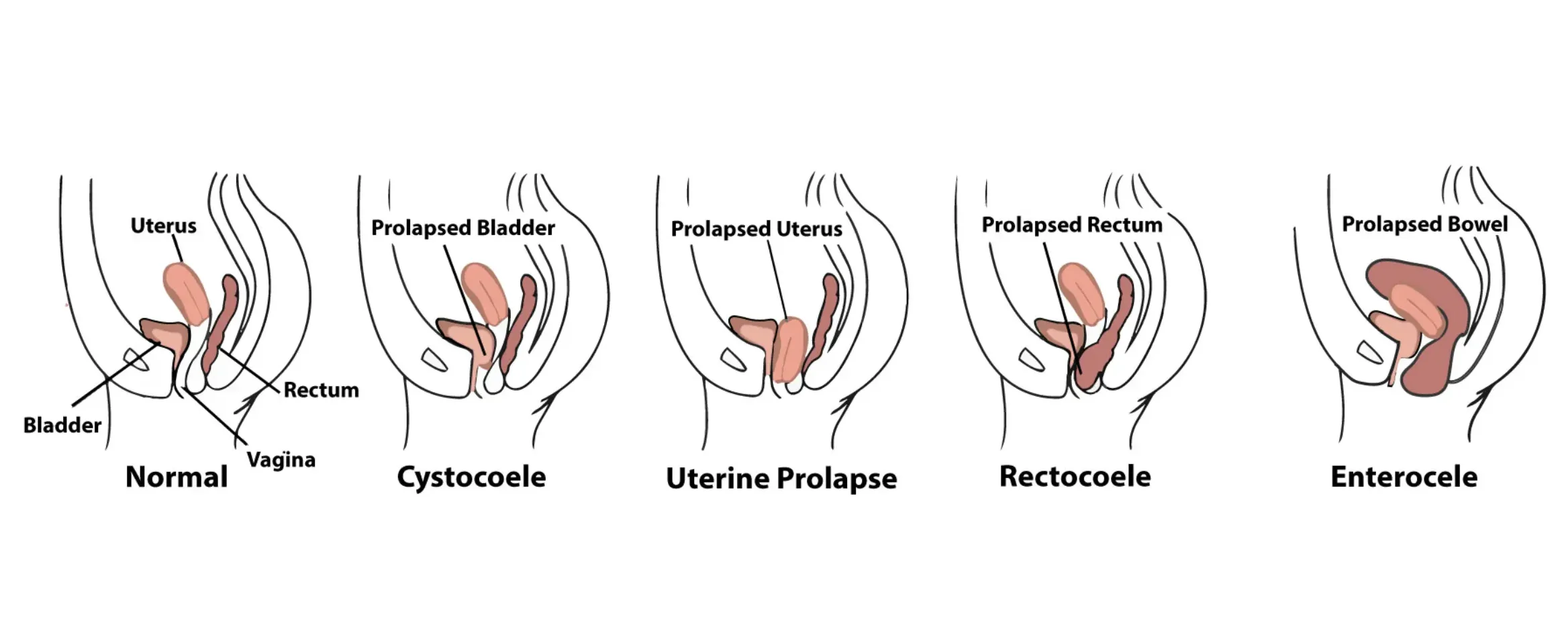 Can Postpartum Prolapse Heal Itself – RYC®