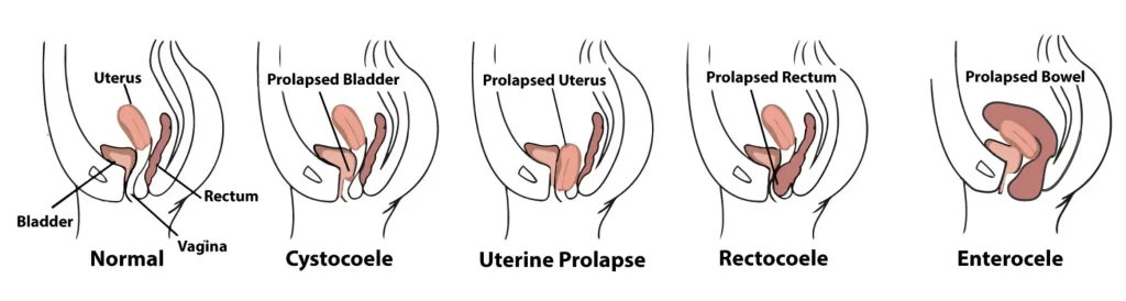 Can Postpartum Prolapse Heal Itself – RYC®