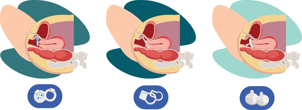 Types of pessaries – RYC®