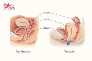 Prolapse – RYC®