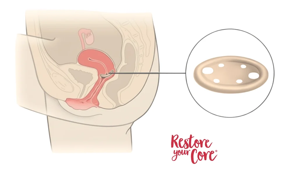 Vaginal Pessary – RYC®