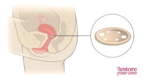 Vaginal Pessary – RYC®