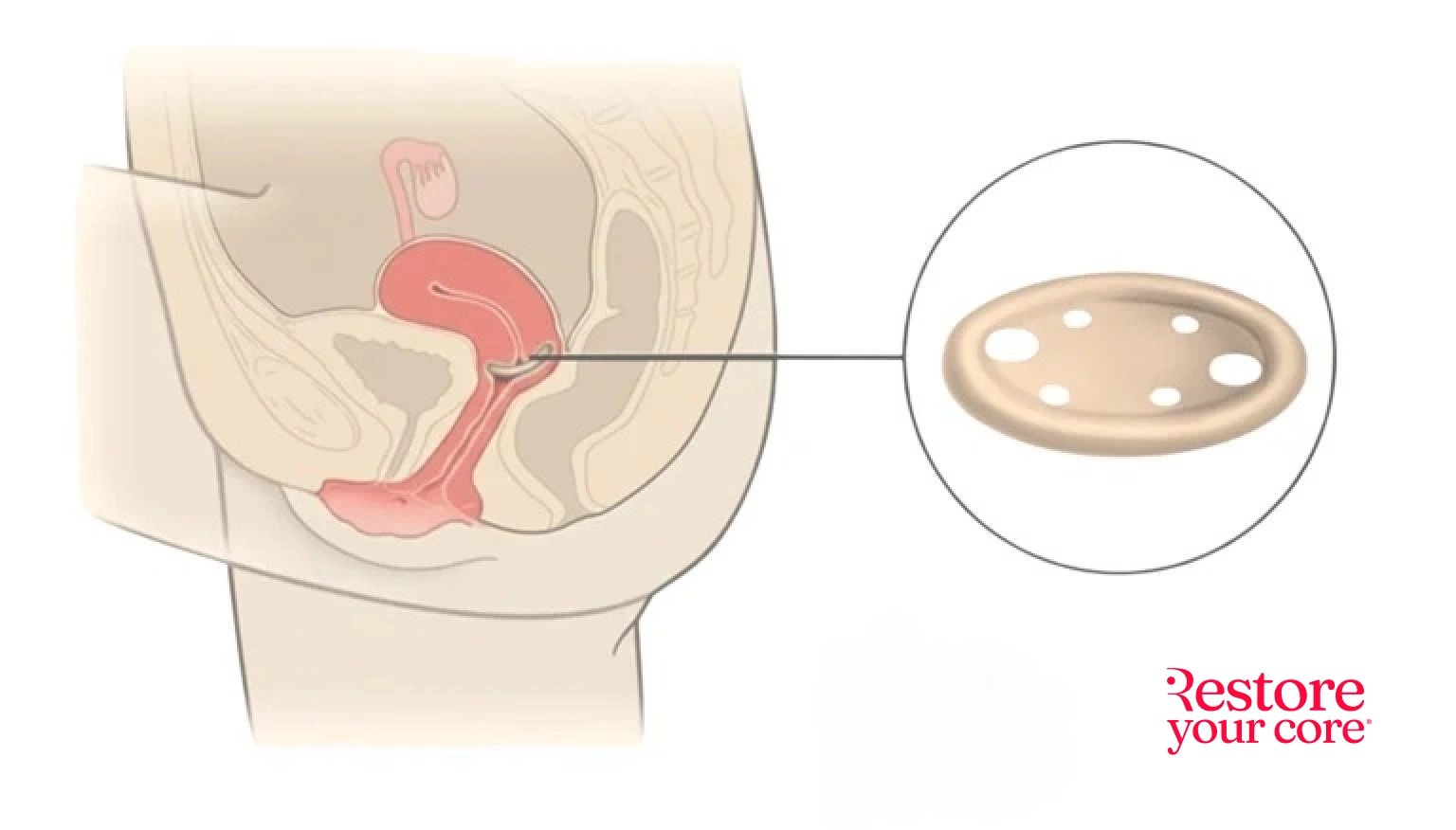 Vaginal Pessary – RYC®