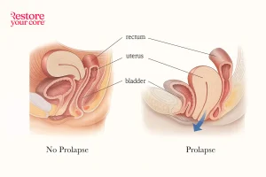 Prolapse – RYC®